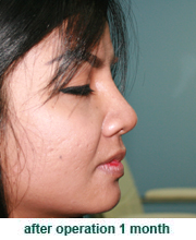 plastic_surgery_augmentation_rhinoplasty